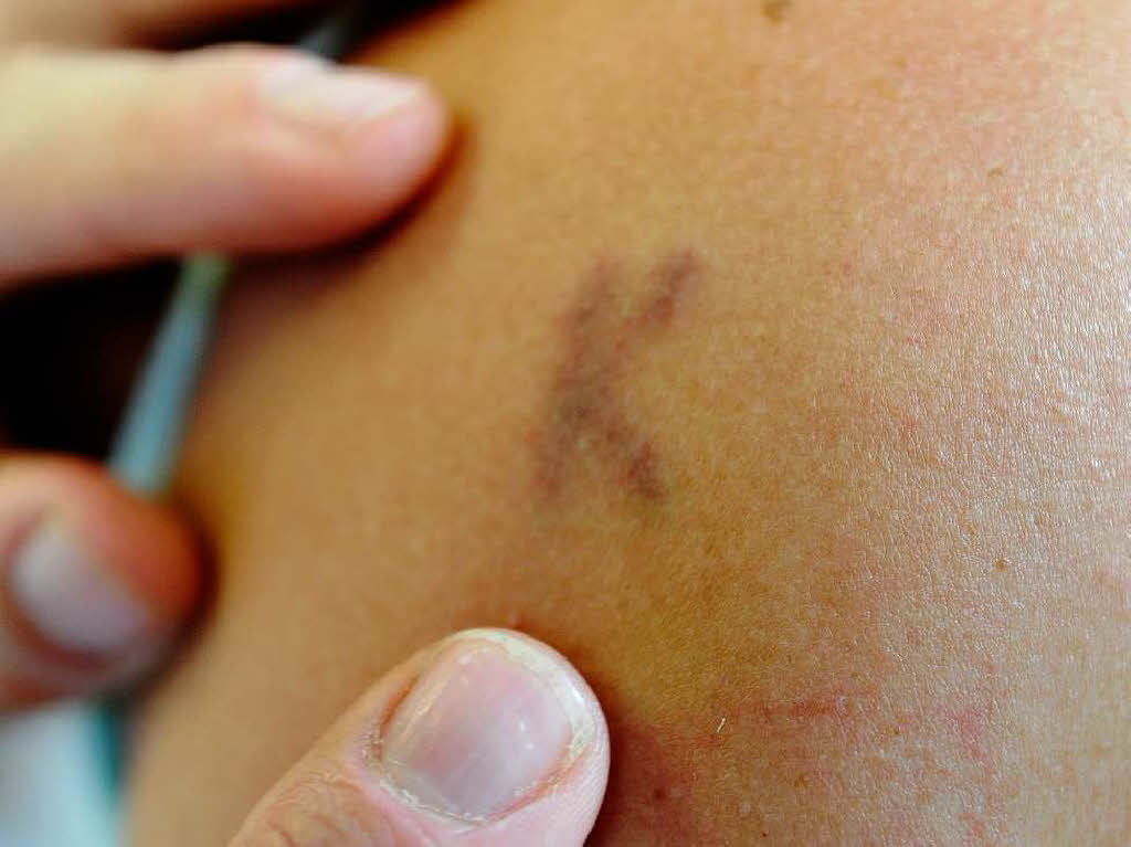 So funktioniert TattooEntfernung mit dem Laser fudder Badische Zeitung