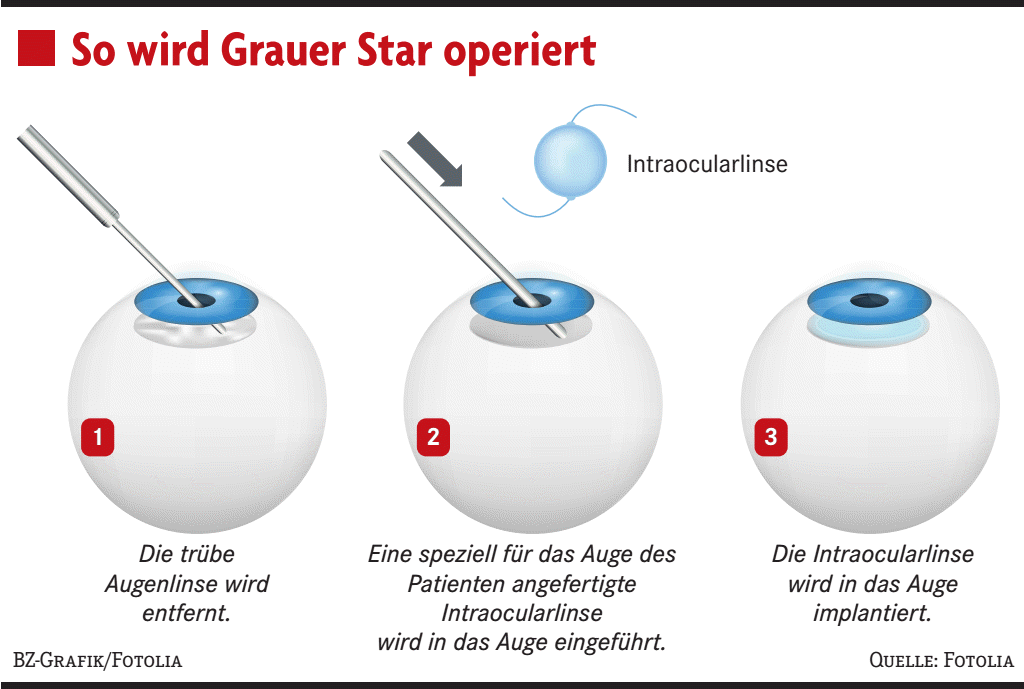 Eine künstliche Linse hilft Patienten mit Grauem Star - Gesundheit