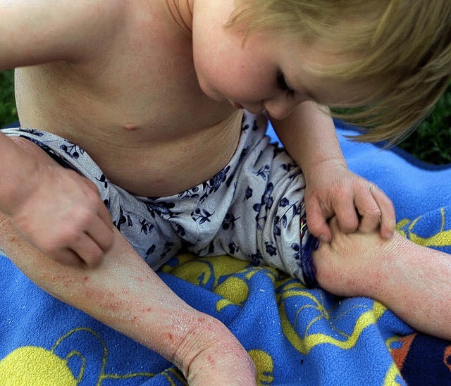 Neurodermitis verursacht nicht nur Juc... die ganze Familie oft auch seelisch.   | Foto: bilderbox.com