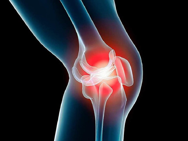 Arthrose fhrt hufig zu Schmerzen im Kniegelenk.  | Foto: Fotolia.com/sebastian kaulitzki