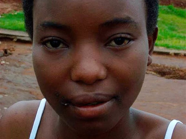 Rose Nduwimana aus Burundi &#8211; ihr..., eine Nebenwirkung ihrer Medikamente.  | Foto: Privat
