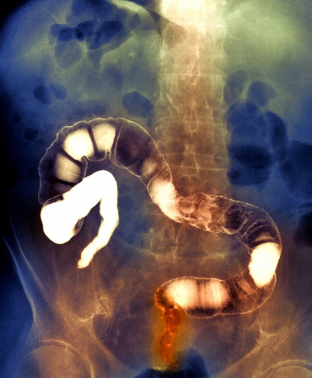 Rntgenbild eines Darmkrebspatienten. ...ngung unten im Mastdarm zu erkennen.    | Foto: Focus