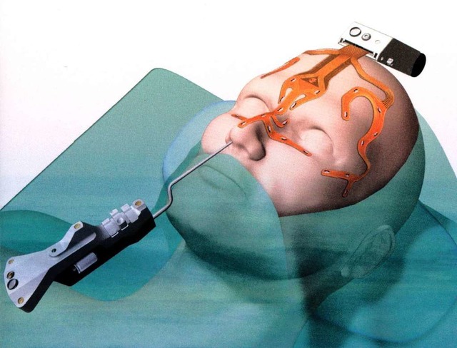 Stryker-Sensoren zeigen dem Arzt, was er tut im Kopf.  | Foto: BZ