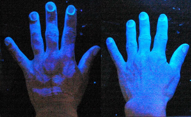 Mit einem fluoreszierenden Mittel und ... UV-Licht  sieht man den Unterschied.   | Foto: helios-klinik