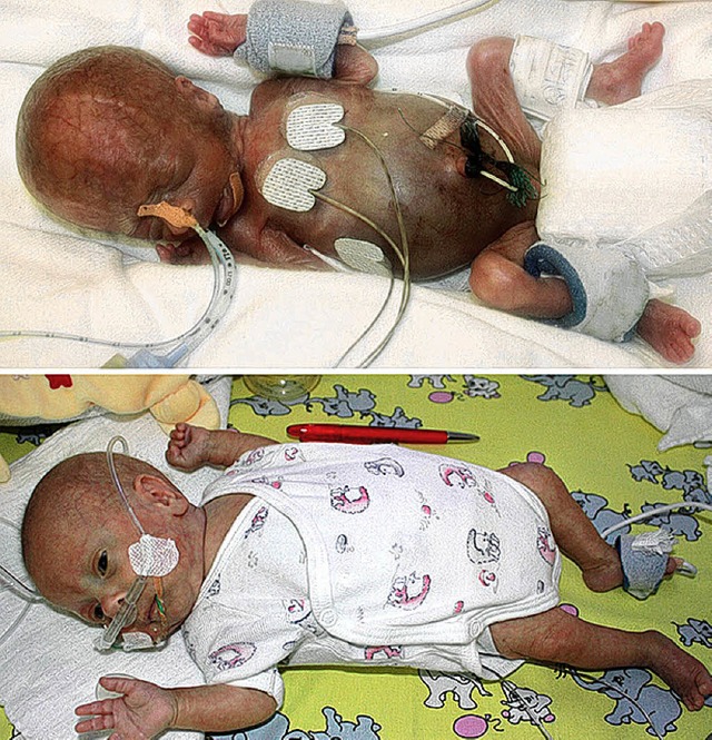 Die Bilder zeigen den Jungen fnf Tage...Geburt (oben) und vier Monate spter.   | Foto: dpa