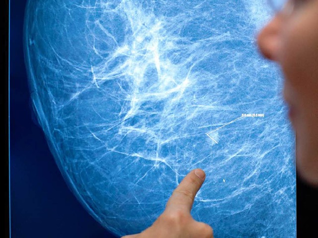 Nicht immer im Rntgenbild zu erkennen: Brustkrebs  | Foto: Verwendung weltweit, usage worldwide