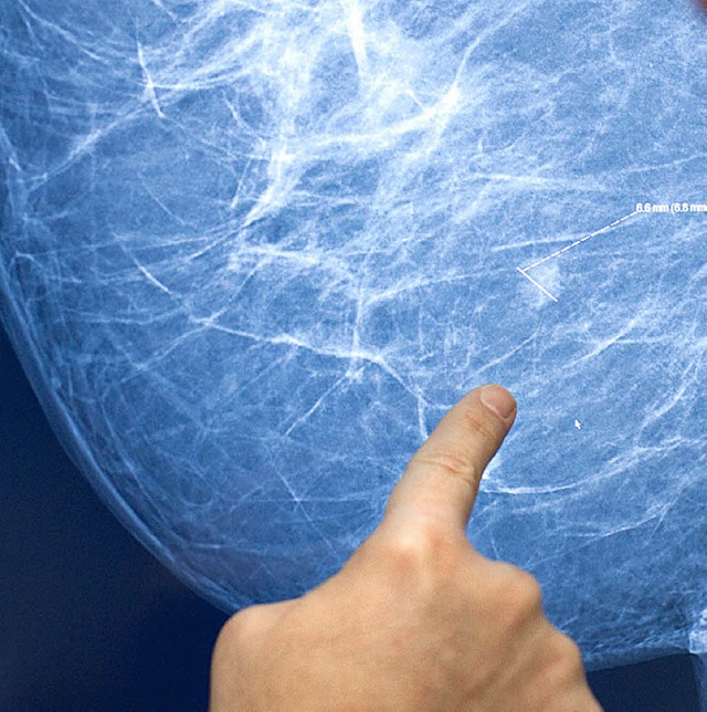 Fingerzeige auf Brustkrebserkrankungen...ie im Computerbild  ausgewertet wird.   | Foto: Friso Gentsch/dpa