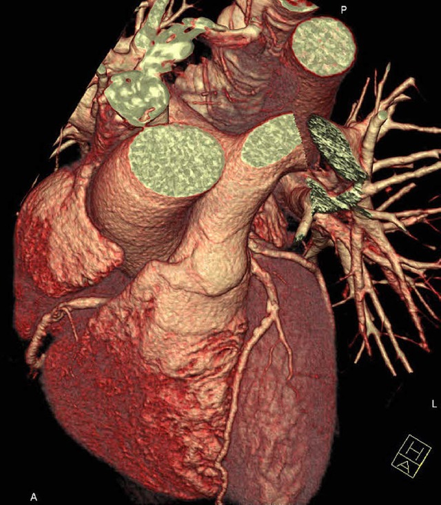 Noch lngst kein Herz und eine Seele: ...ngen. Oben: Das CT-Bild eines Herzens   | Foto: HZ
