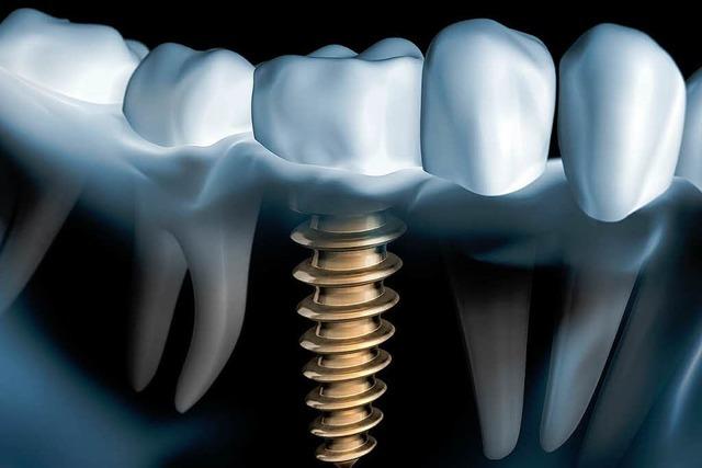 Unsicherheit um Zahn-Implantate