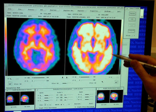 Vergleich von Hirnaufnahmen eines gesu... (links) und eines Alzheimerpatienten.  | Foto: Verwendung weltweit, usage worldwide