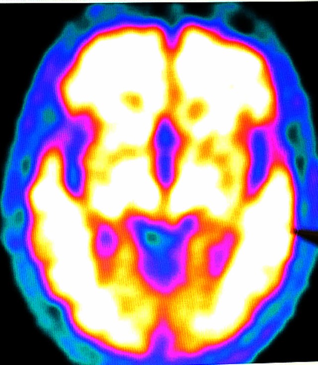 Gehirnbild  (MRT + PET) eines Alzheimerkranken  | Foto: dpa
