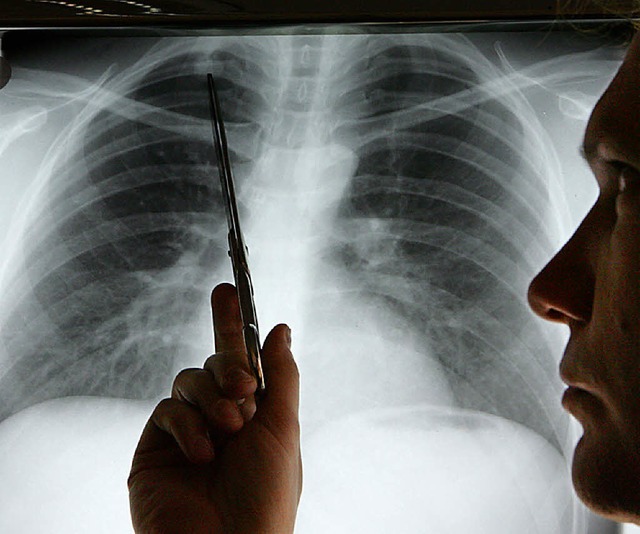 Diognose Lungenkrebs  | Foto: Verwendung weltweit, usage worldwide