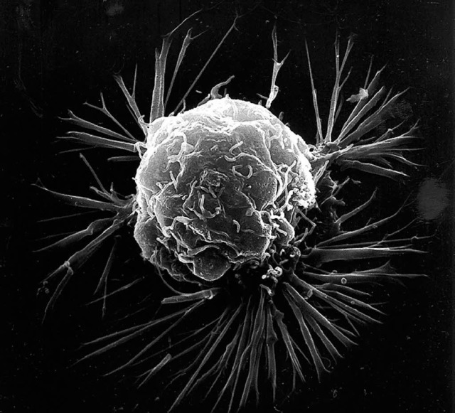 Brustkrebs-Zelle  | Foto: ce: National Cancer Institute