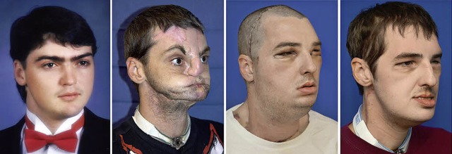 Richard Norris&#8217; Gesicht war 15 J...izinern eine Transplantation geglckt.  | Foto: dpa