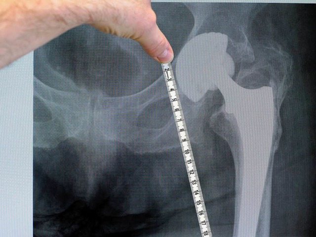 Hftprothese im Rntgenbild (Symbolbild)   | Foto: Bergring (fotolia.com)