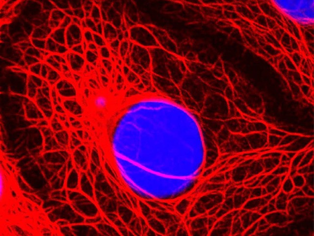 Gefrbte Brustkrebszelle unter dem Mik...steten Nachschub an neuen Krebszellen?  | Foto: Deutsche Presse-Agentur