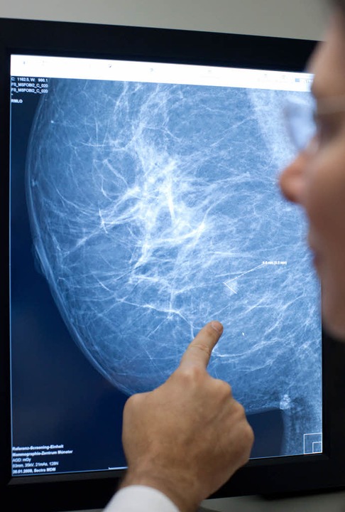 Das Brustkrebsrisiko bei einem Gendefekt kann sehr hoch sein.  | Foto: dpa