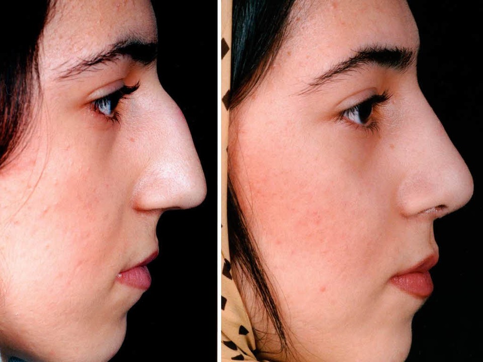 Vorher und nachher: Schönheits-Operationen bei Iranerinnen weit verbreitet....