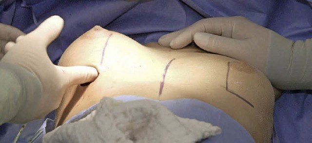 Bei einer Brustvergrerung in Hamburg wird ein Silikon-Implantat eingesetzt.   | Foto: dpa