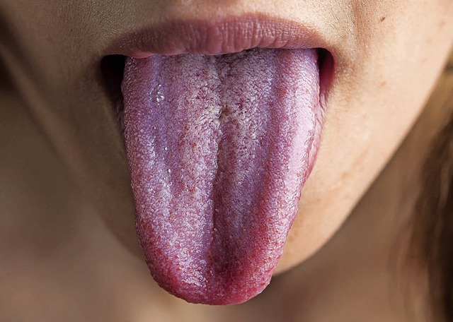 Die Zunge ist in der Regel glatt, samt...nnte eine Krankheit die Ursache sein.   | Foto: Pro Dente