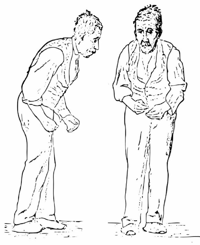 Zeichnung eines Parkinsonkranken in ei...en Lehrbuch aus dem 19. Jahrhundert.    | Foto: Wikipedia/AFP