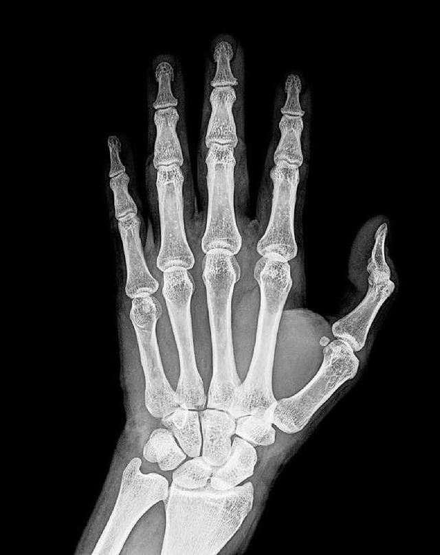 Rntgenbild der Hand  | Foto: fotolia