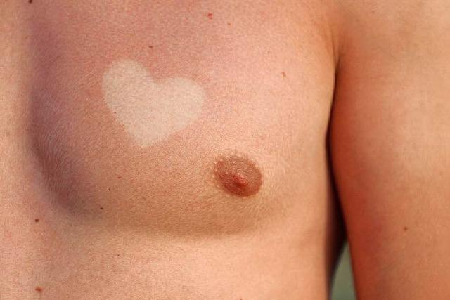 Herzförmiger Hautkrebs? Trend zu Sonnenbrand-Tattoos