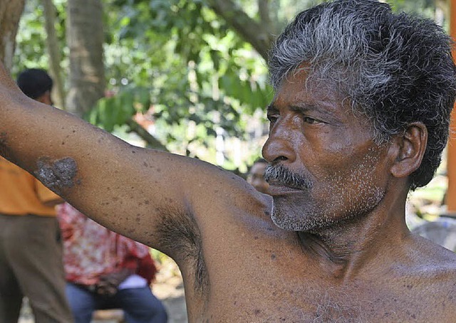 Landarbeiter Manatosh Bisulas zeigt seine schwarzen Flecken am Arm.   | Foto: thomas krause