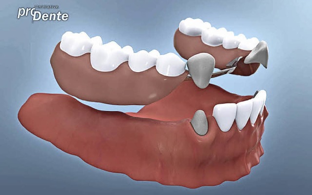 Kombinatinszahnersatz  | Foto: Initiative Pro Dente