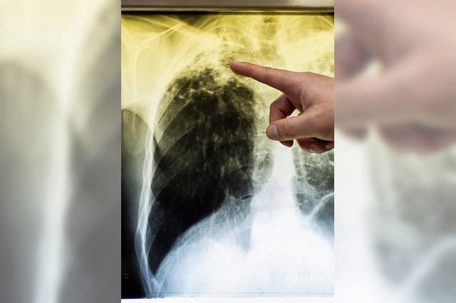 Es gibt wieder mehr Tuberkulose-Fälle in der Ortenau