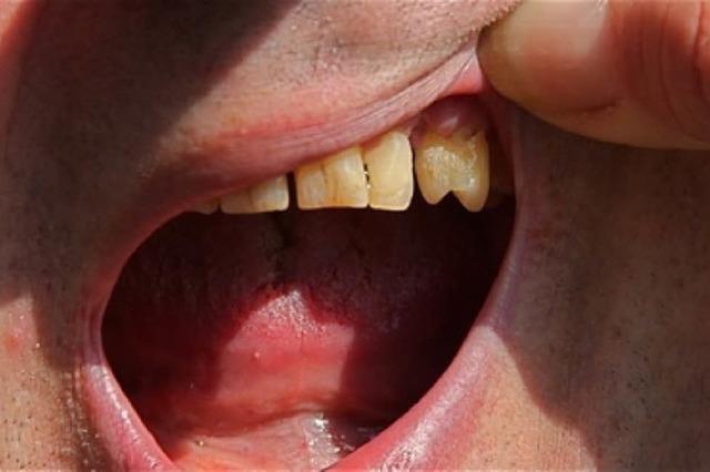 Oralphobie: Die Angst vorm Zahnarzt