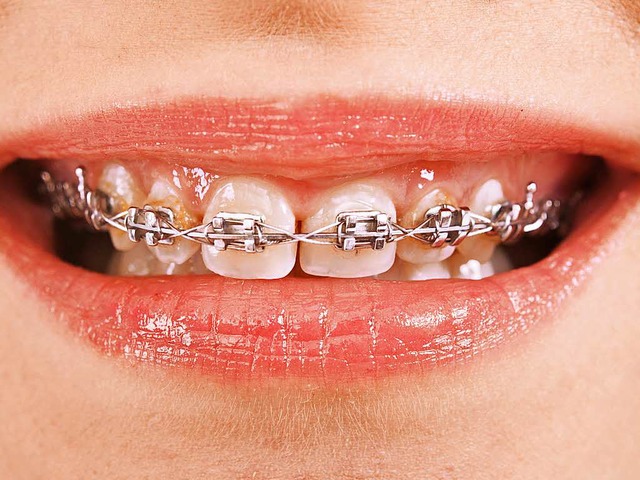 Sind Zahnspangen wirklich ntig?   Darber streiten Experten.  | Foto: Colourbox.de