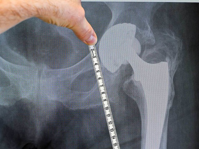 Eine Hftprothese in der  Rntgenaufnahme  | Foto: fotolia.com/Bergringfoto