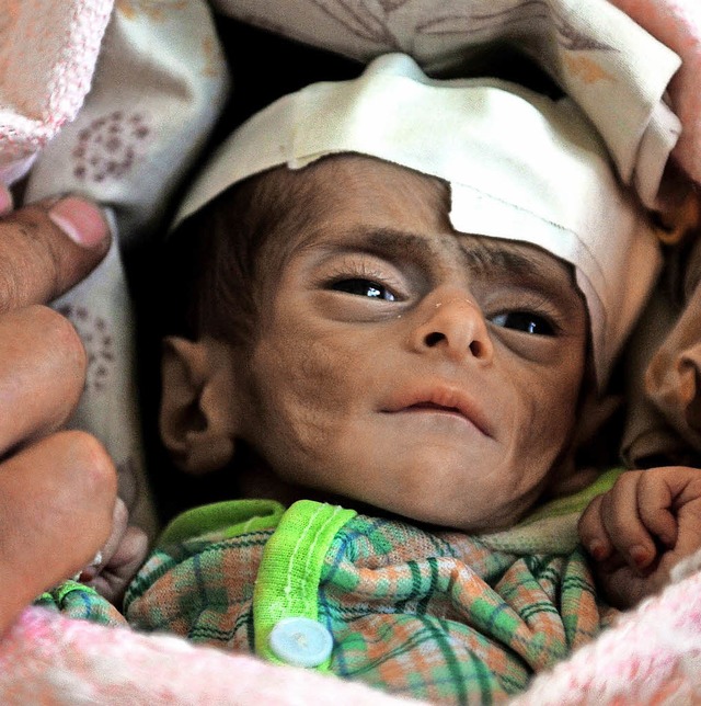 Schwer unterernhrtes Kind im Jemen   | Foto: dpa