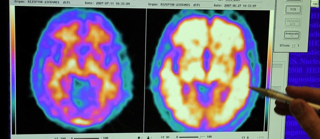 Hirnaufnahmen von einem gesunden Probanden (links) und einem Alzheimerpatienten   | Foto: dpa
