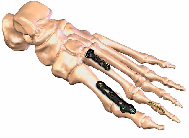 Rund zwlf Millionen Menschen haben in...twickelt Axomed innovative Implantate.  | Foto: Pr / Axomed