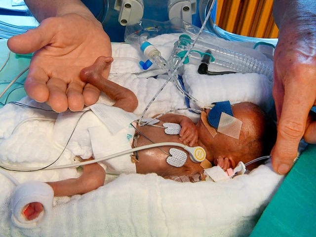 Ein frh geborenes Mdchen wurde am Kl... dadurch schwere Schden. (Symbolbild)  | Foto: dpa