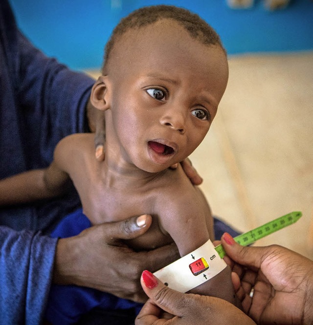 Unterernhrtes Kind in Mali   | Foto: DPA