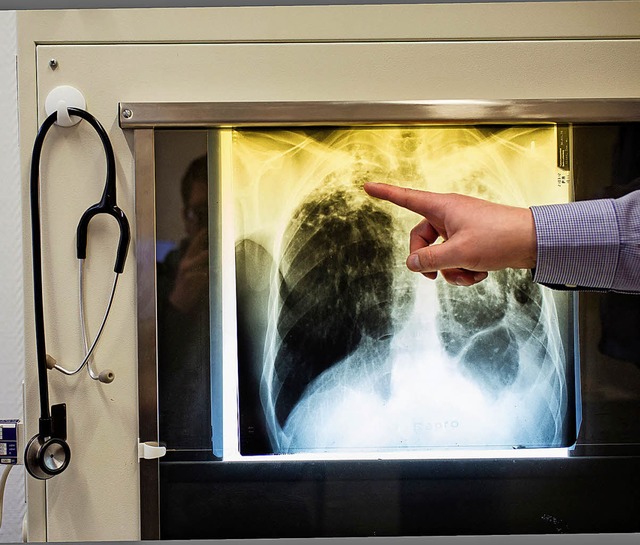 Die Rntgenuntersuchung ist immer noch...um Erkennen einer offenen Tuberkulose.  | Foto: DPA