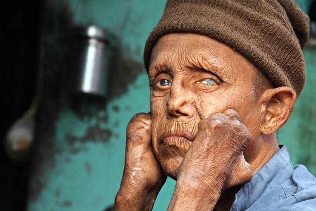 Ein an Lepra erkrankter Mann in Indien...Kolonie der nordindischen Stadt Jammu.  | Foto: dpa