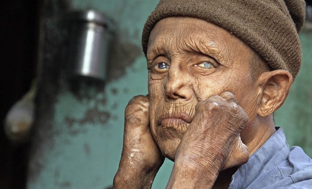 Ein an Lepra erkrankter Mann in Indien...olonie der nordindischen Stadt Jammu.   | Foto: dpa