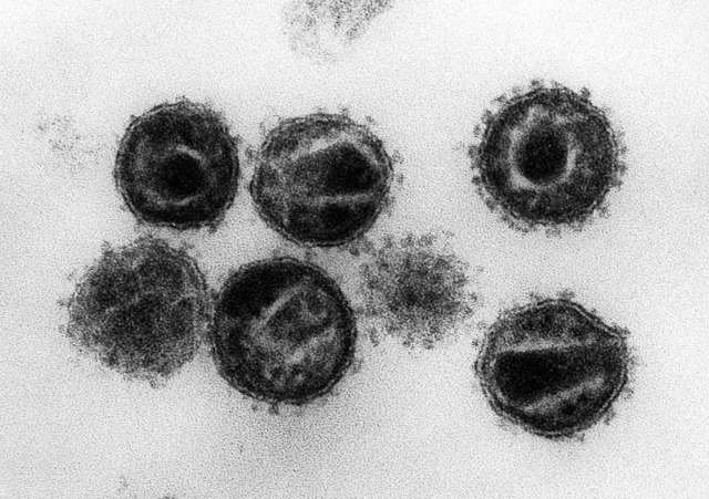 So sehen HIV-Viren unterm Elektronenmikroskop aus.   | Foto: dpa