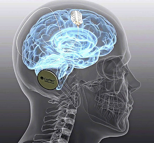Das Cortec-Implantat kommuniziert mit dem Gehirn.   | Foto: fotos: Cortec