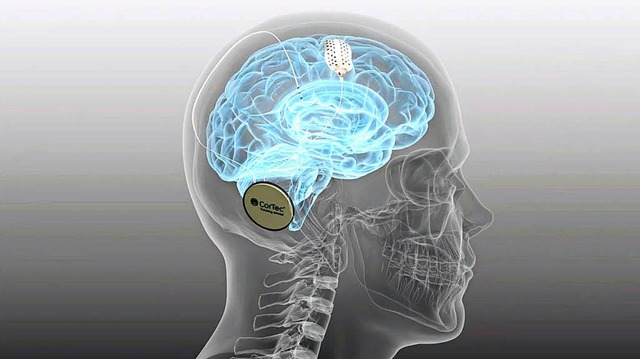 Das Cortec-Implantat arbeitet mit dem Gehirn zusammen.    | Foto: fotos: Saltzer-Deckert, Cortec