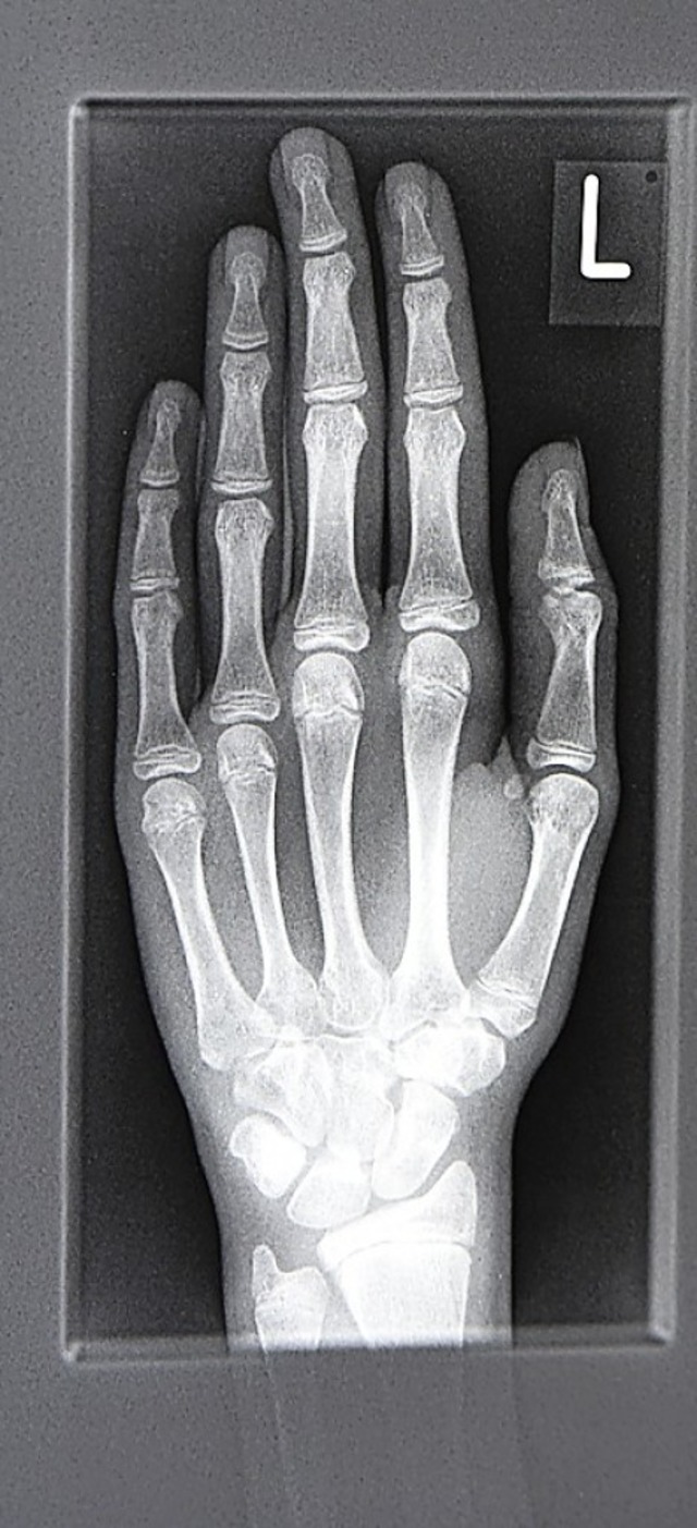 Rntgenaufnahme einer linken Hand   | Foto: dpa