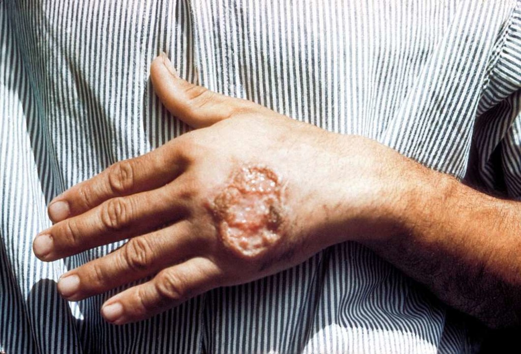 Aus einem infizierten Stich entstehen ... langwierige Wunden mit großen Narben.  | Foto: Dr. D. S. Martin ( Centers for Disease...n's Public Health Image Library (PHIL)