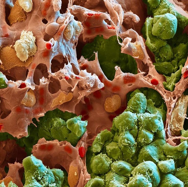 Metastase in der Lunge einer Maus. Tumorzellen sind grn gefrbt.  | Foto: DKFZ