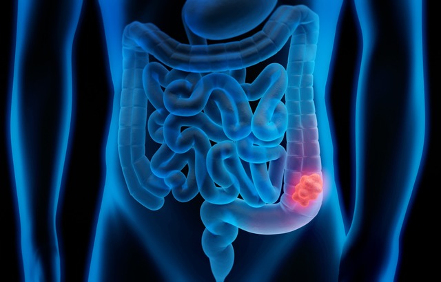 Visualisierung eines Darmpolyps, aus dem sich Darmkrebs entwickeln kann.  | Foto: peterschreiber.media (stock.adobe.com)