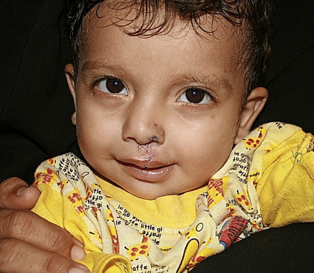 Der Junge nach der Behandlung   | Foto: Deutsche Cleft Kinderhilfe