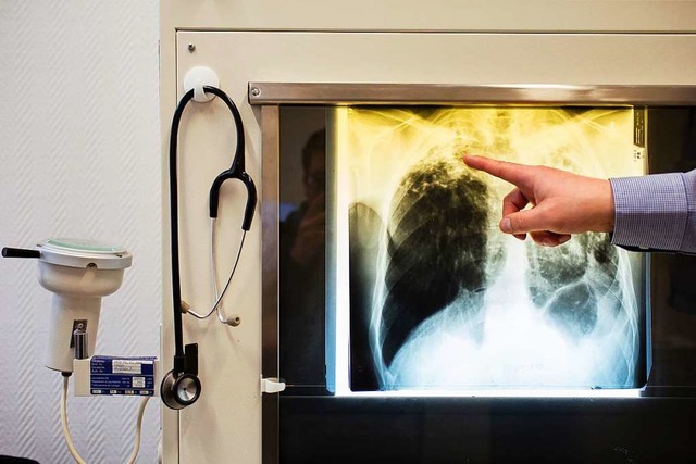 Ein Arzt zeigt einen Tuberkulose-Fall anhand eines Rntgenbildes (Symbolbild).  | Foto: Gregor Fischer